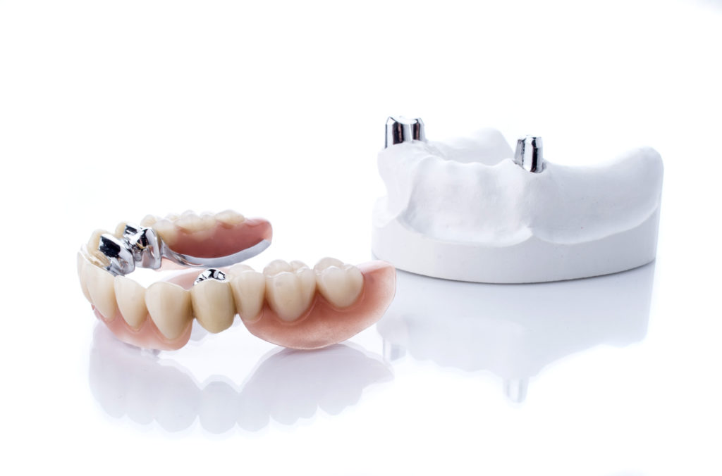 Klare Aufnahme einer Zahnprothese im Dentallabor, die detailliert die Form und Struktur der Prothese zeigt.